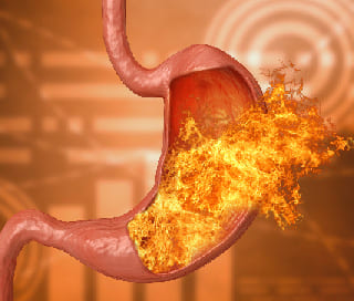 tratamiento-por-reflujo-gastroesofagico-en-cdmx